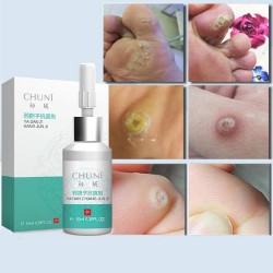 Liquid for removing skin tags - moles - warts - lightening freckles - 10mlSkin