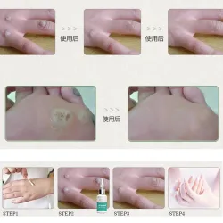 Mole Skin Tag Repair Solution Painless Mole Skin Dark Spot Repair Face Wart Tag Freckle Repair CreHuid