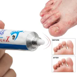 Antibacteriële voetzalf - tegen jeuk - likdoorns verwijderen - tegen zweten - tegen geurtjes - psoriasisVoeten