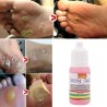 Skin tag removal - voetwratten - medische vloeistof - 10ml - 2 stuksHuid