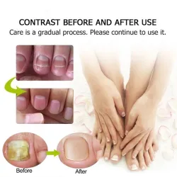 Schimmelnagelbehandeling - hand/voeten/nagelcreme - ginseng - 15 grBehandeling